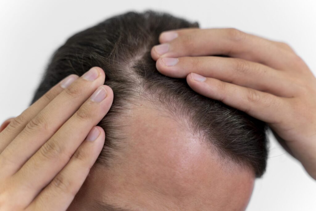 6 Strategies to Prevent Hair Loss in Men: Your Comprehensive Guide