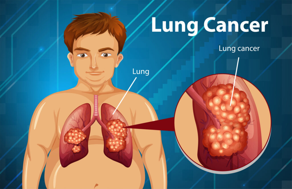  Understanding Lung Cancer: Causes, Symptoms, Diagnosis, Treatment, and Prevention  