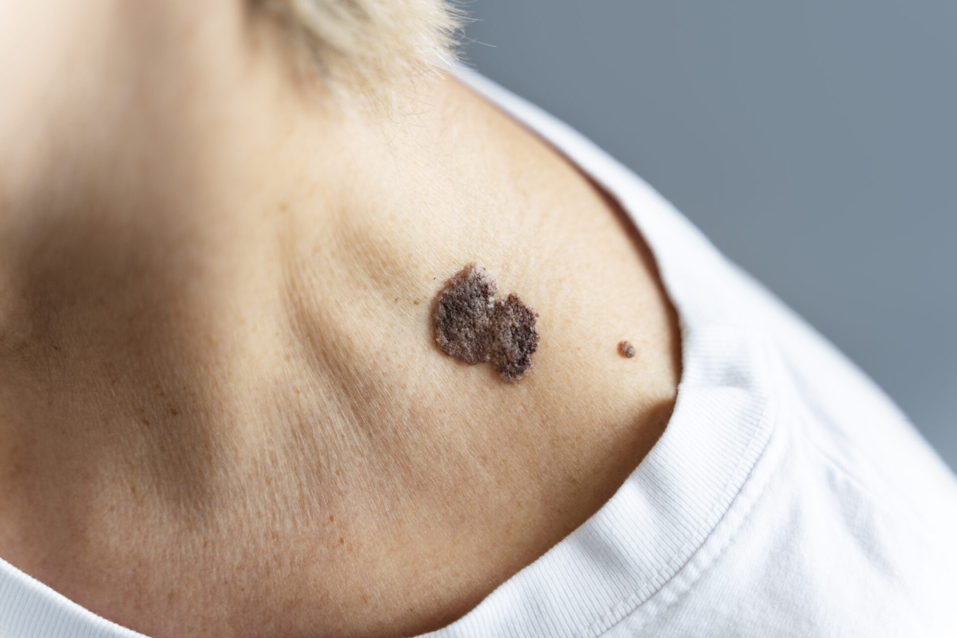 Understanding Skin Cancer: Types, Causes, Symptoms, and Treatment