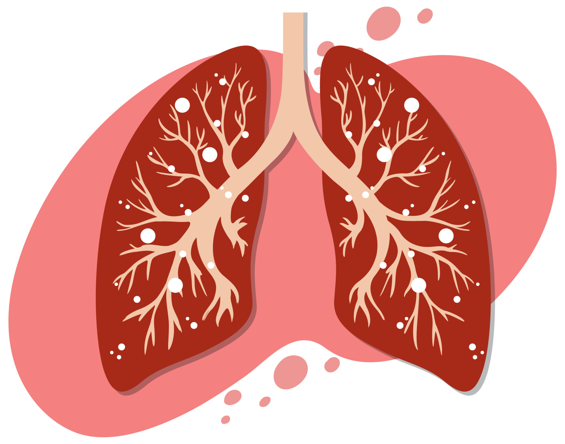 Understanding Lung Cancer: Causes, Symptoms, Diagnosis, Treatment, and Prevention