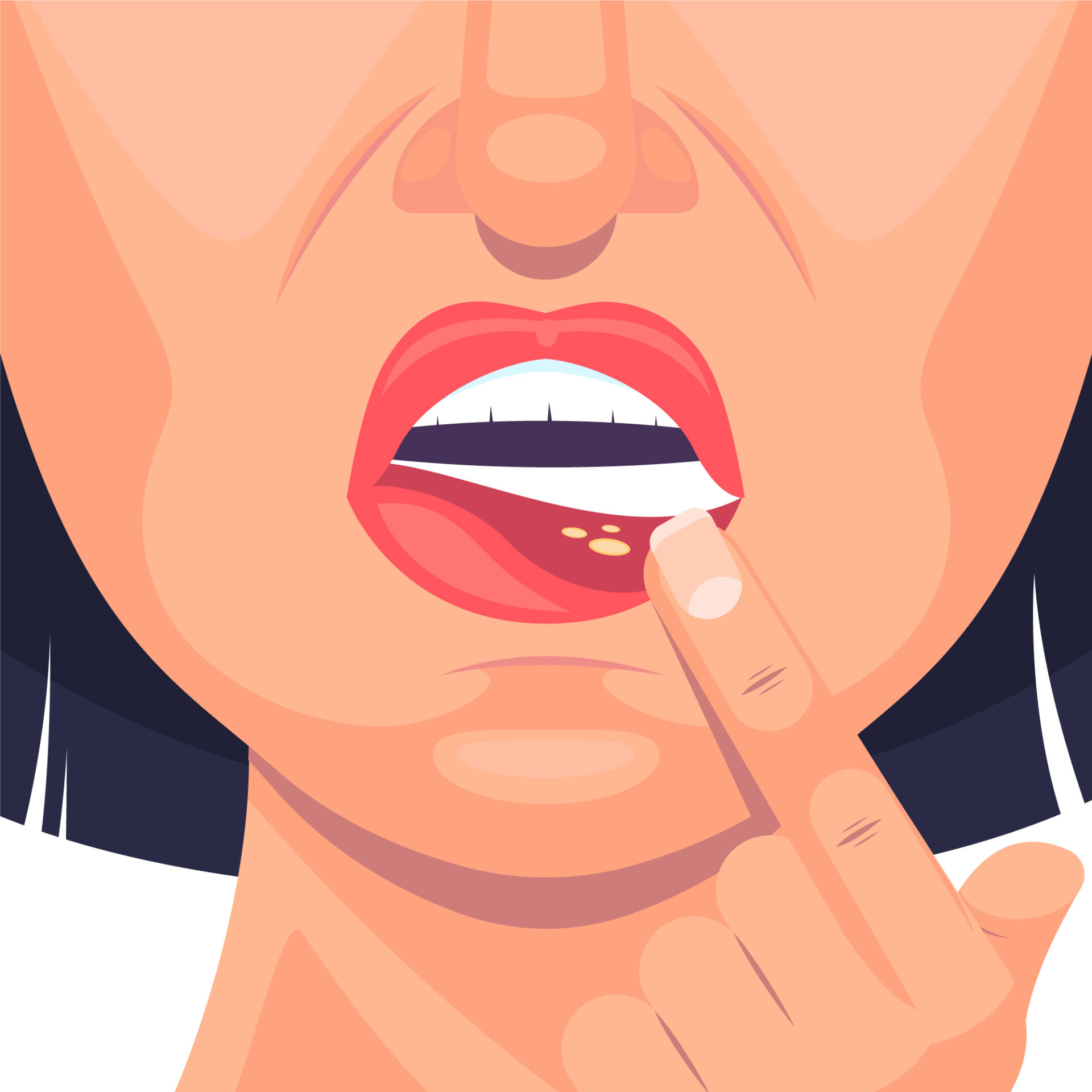 How to Get Rid of Canker Sores: Fast Relief and Prevention Tips for a Pain-Free Mouth