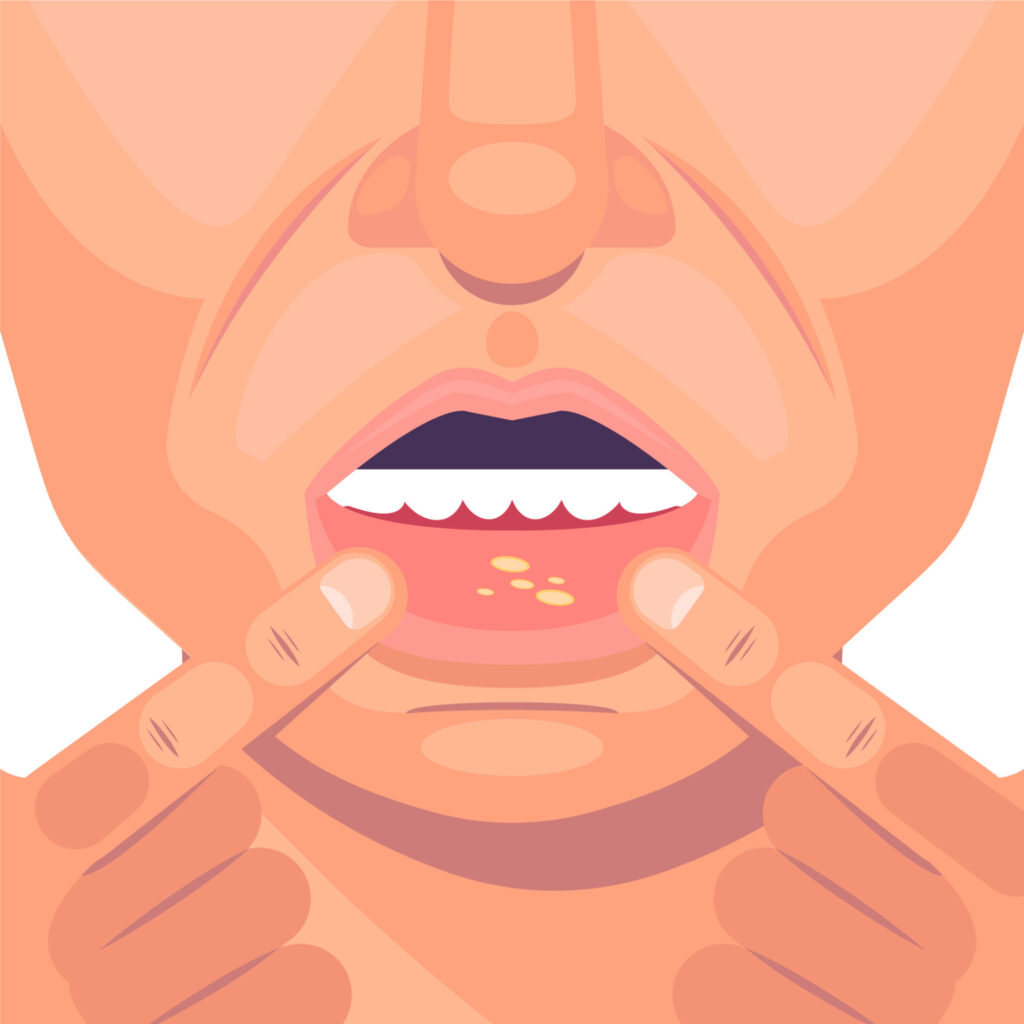 How to Get Rid of Canker Sores: Fast Relief and Prevention Tips for a Pain-Free Mouth