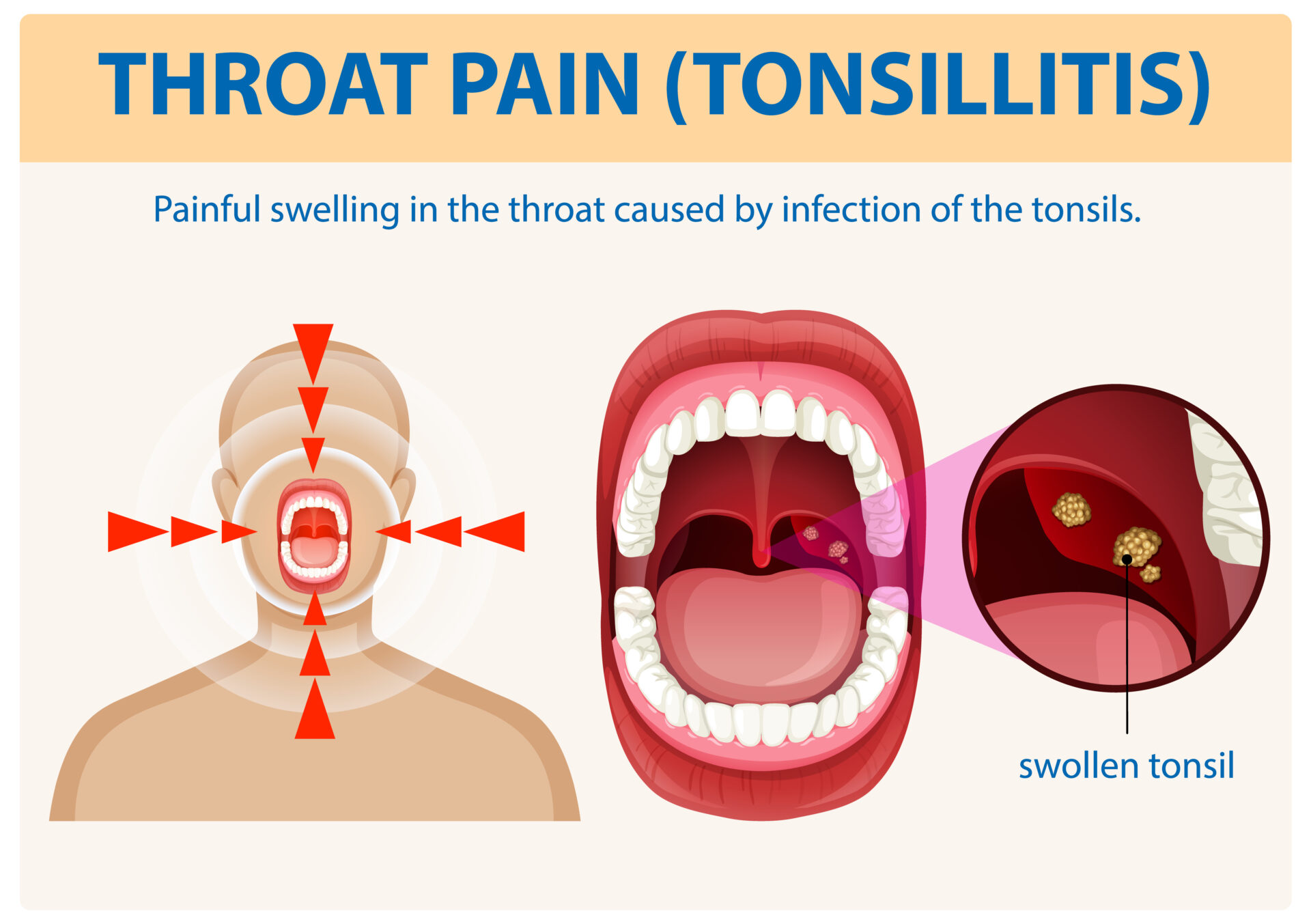 Is Tonsillitis Contagious? Understanding Causes, Transmission, and Recovery Tips